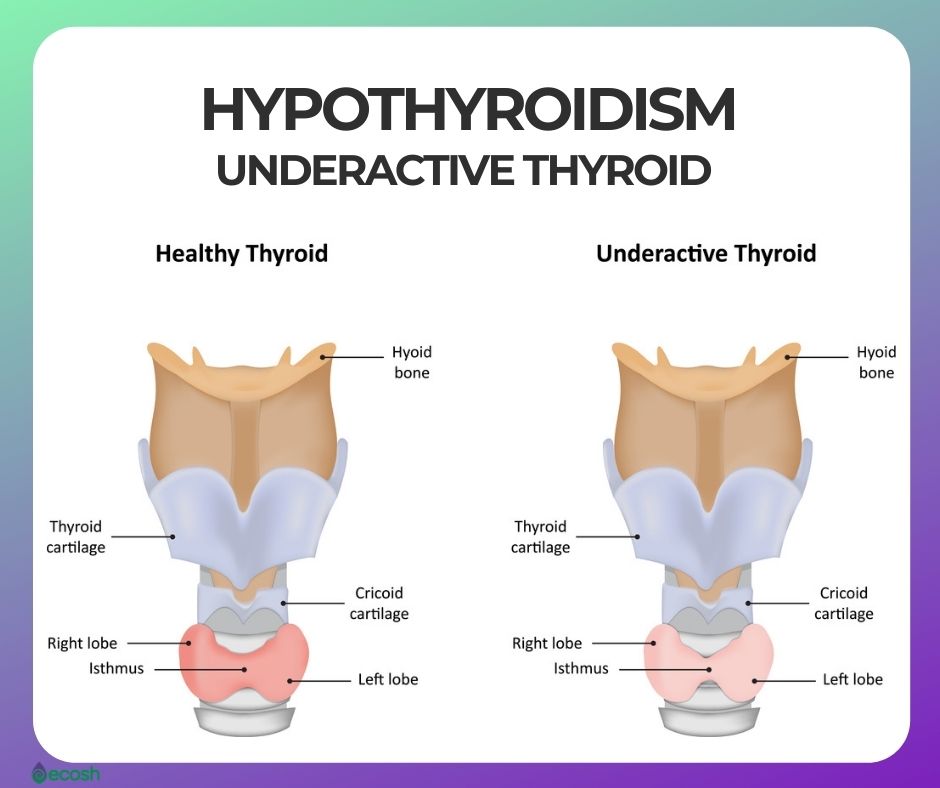 Thyroid: दुनियाभर की 40% आबादी Thyroid से है ग्रसित, जानें क्या है थायरॉयड और कैसे पाएं निजात 6 Thyroid