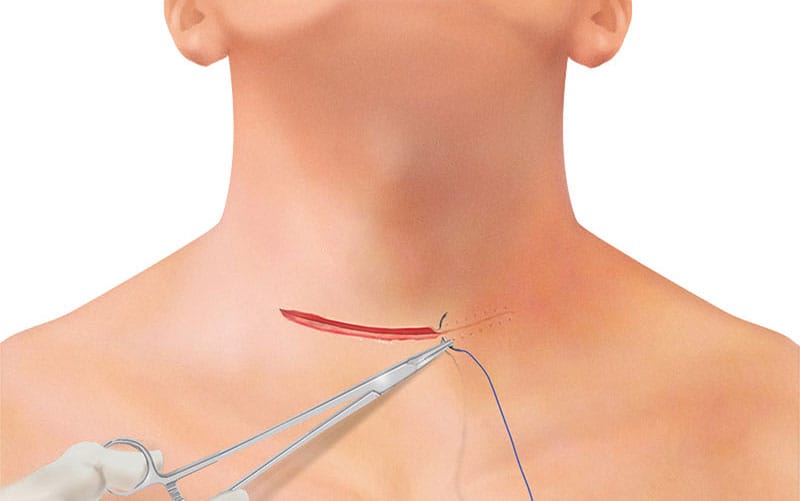 Thyroid