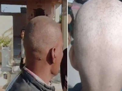 Hairfall Issue in Maharashtra: सूखे पत्तों की तरह 3 गांव के लोगों के बाल क्यों उड़ गए? पता चल गई गंजेपन की वजह