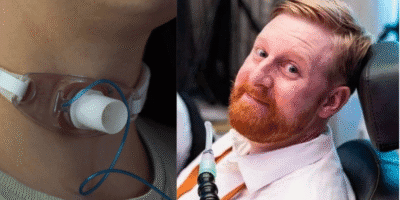 Tracheostomy